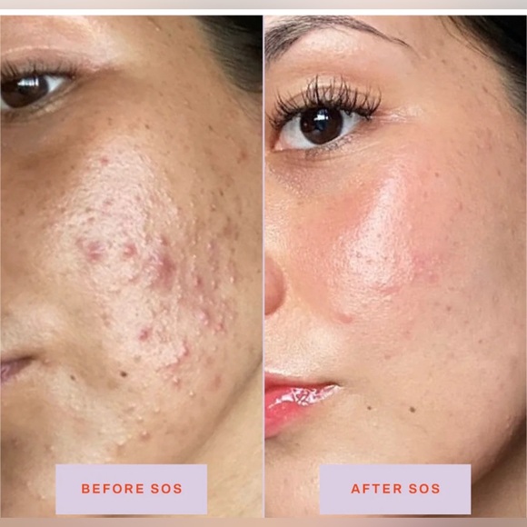 New SOS Tower 28 Daily Rescue Facial Spray - Spray Protecteur for Skin Flare-Ups - Picture 4 of 13